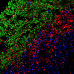 Accumulation of immune cells: B cells (green) and T cells (red)