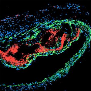 Autoantibodies target the diseased arterial wall containing atherosclerotic plaques (red autoantibodies); smooth muscle cells (green).