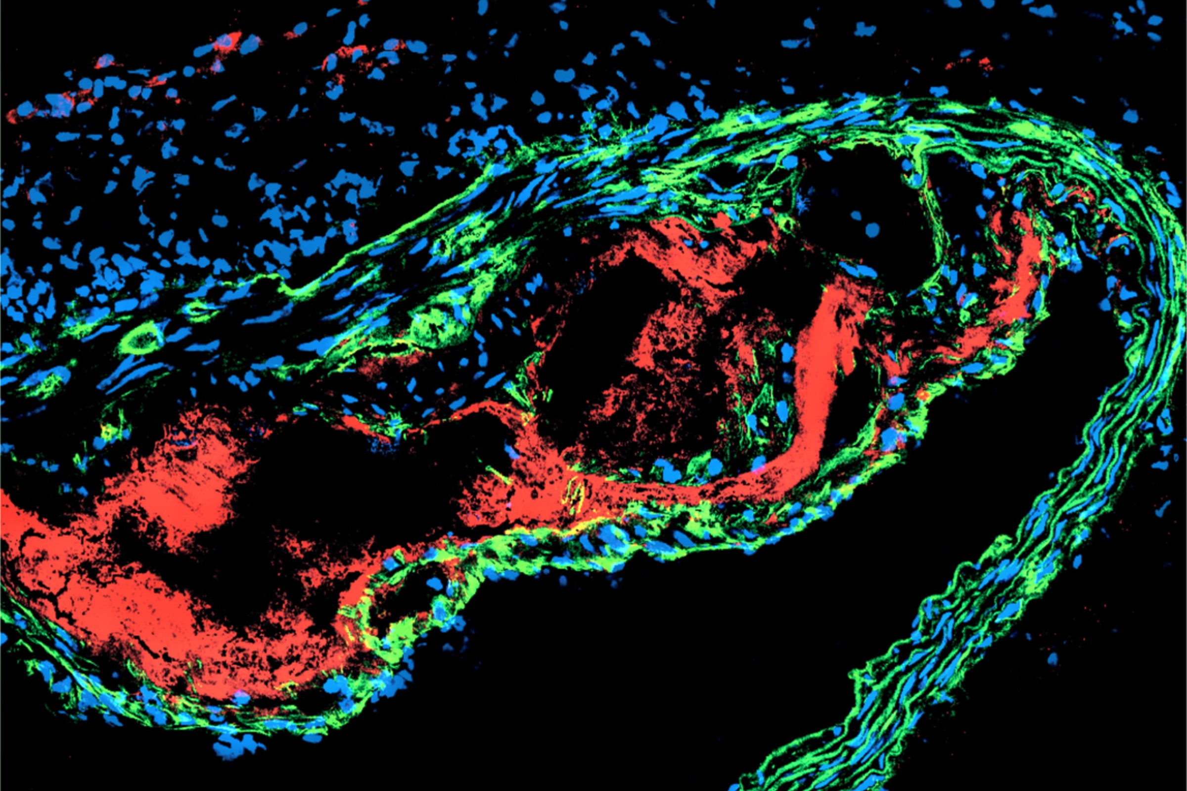 アテローム性動脈硬化症は自己免疫疾患であることを示す（Atherosclerosis is an Autoimmune Disease）