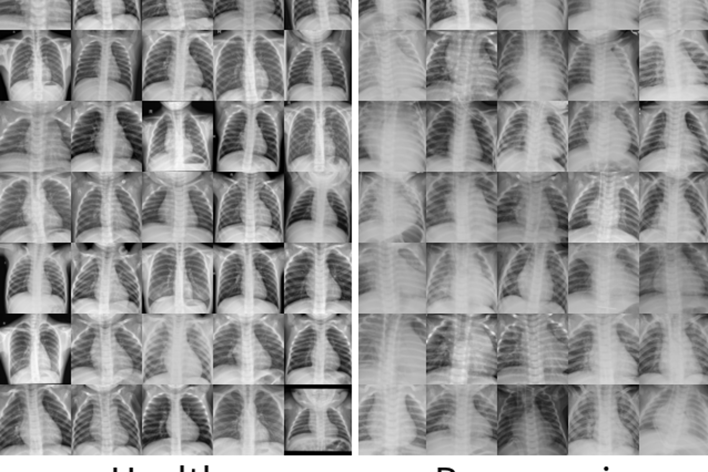 量子AIを用いた肺炎診断技術を開発（Detecting pneumonia with quantum AI）
